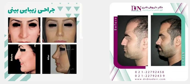 عمل بینی استخوانی