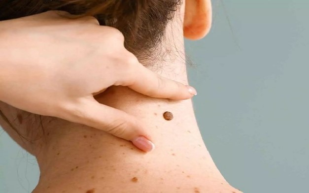 آیا خال گوشتی خطرناک است؟