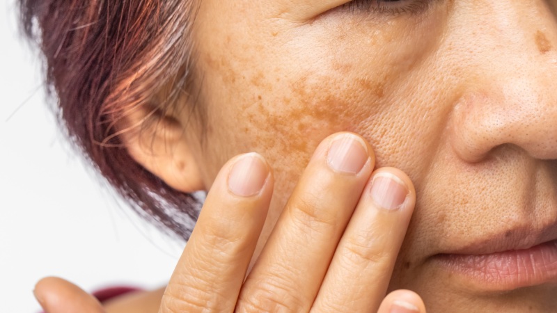 چگونه از ایجاد لک های پیری پیشگیری کنیم؟