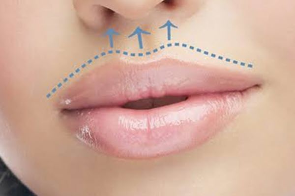 لیفت لب چطور به زیبایی چهره کمک می‌کند