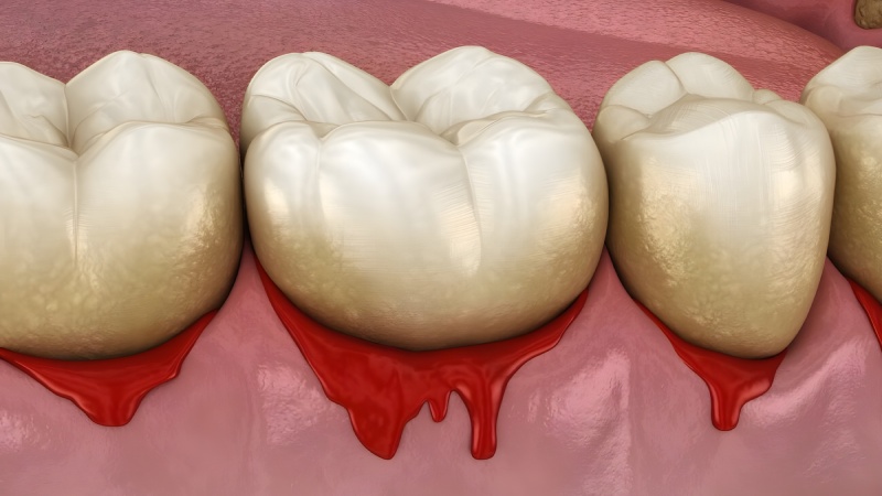 آیا خونریزی لثه یعنی خطر ابتلا به آلزایمر بیشتر شده است؟