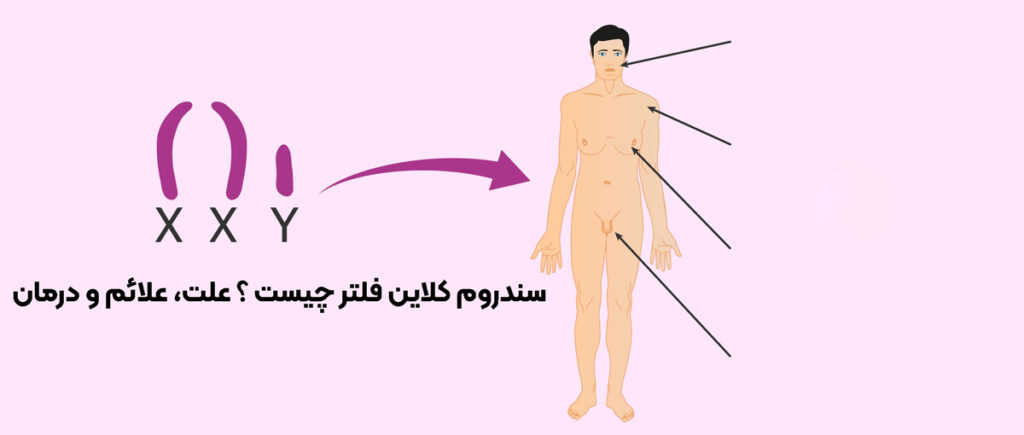 سندروم کلاین فلتر چیست ؟ علت، علائم و درمان