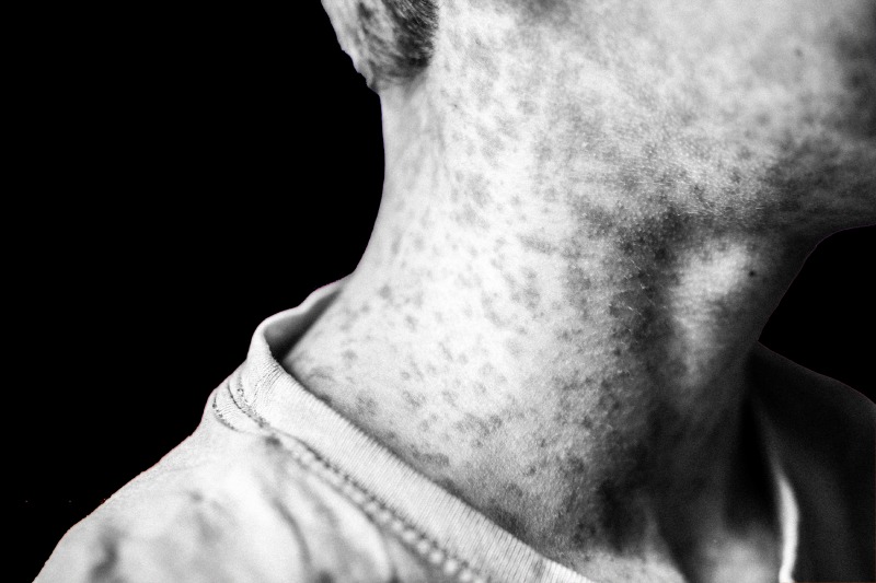 شیوع دوباره سرخک در جهان؛ چرا واکسیناسیون حیاتی است؟
