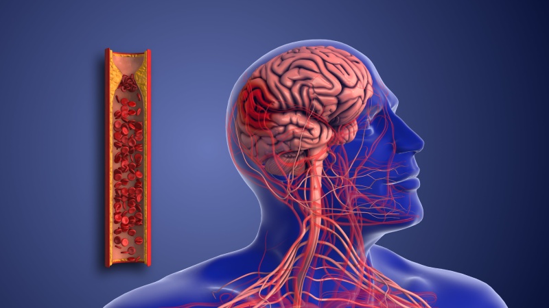 هشدار سکته مغزی: علائم حیاتی و نکات ضروری برای پیشگیری