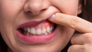بیماری لثه و دیابت نوع ۲ چه ارتباطی دارند؟ هشدار درباره افزایش خطر ابتلا به دیابت