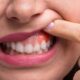 بیماری لثه و دیابت نوع ۲ چه ارتباطی دارند؟ هشدار درباره افزایش خطر ابتلا به دیابت
