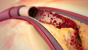 آترواسکلروز چیست؟ بررسی علائم، علل، عوامل خطر، تشخیص و درمان تصلب شرایین